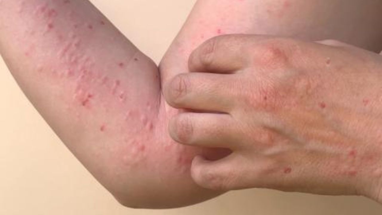 Confirman más caso de viruela símica en Panamá